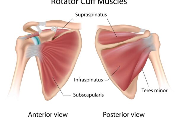 What-Are-Supraspinatus-and-Subscapularis-Tendinosis